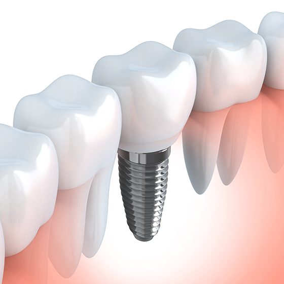 Tooth human implant (done in 3d graphics)